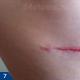 Laser treatment of keloid scars