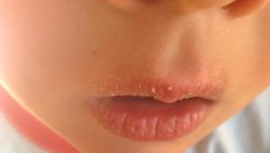 Why do lips peel and what to do?