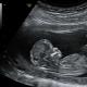 Ultrasound during pregnancy: transcript Ultrasound examination pregnancy