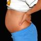 Termination of pregnancy in the second trimester Miscarriage at 14 weeks of pregnancy causes