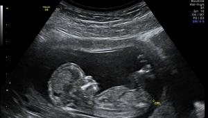 Ultrahang terhesség alatt: átirat Ultrahang vizsgálat terhesség